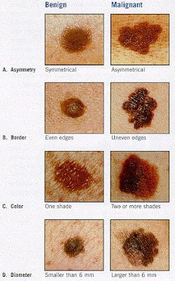 Benign and Malignant Melanomas A, B, C, and D