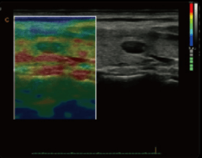 Quantitative Elastograhpy