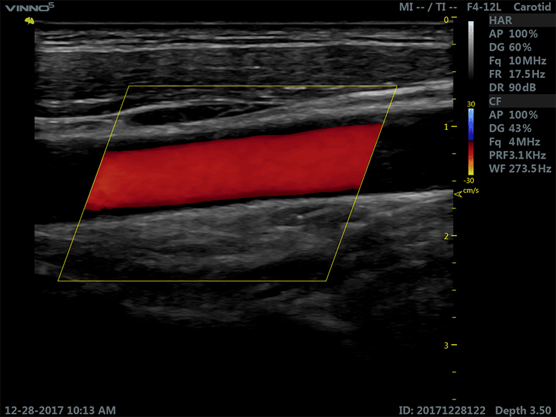 ecografia doppler ecografo vinno 5