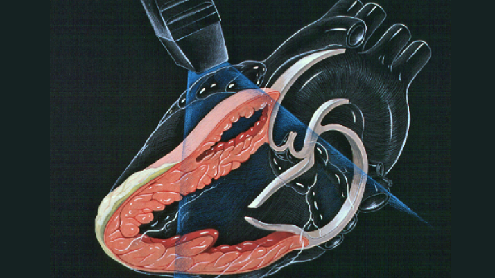 Técnica Strain