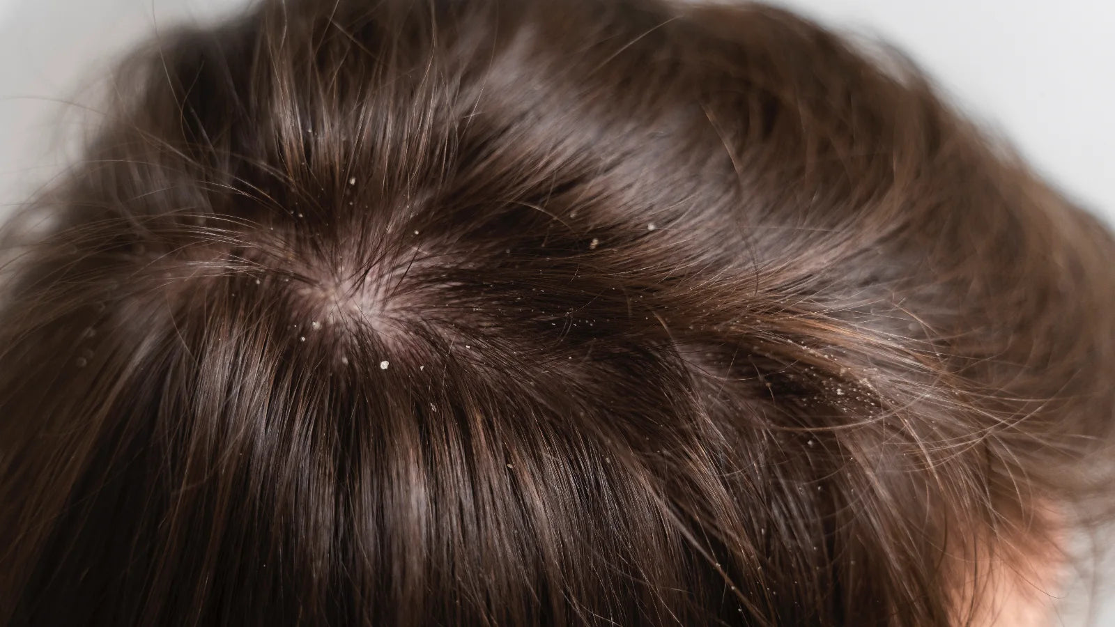 Why do you get dandruff?