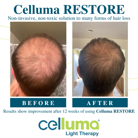 Celluma Restore - before and after - hairloss