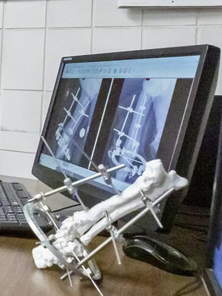 The hybrid external fixator used to plan the non-union fracture revision surgery.