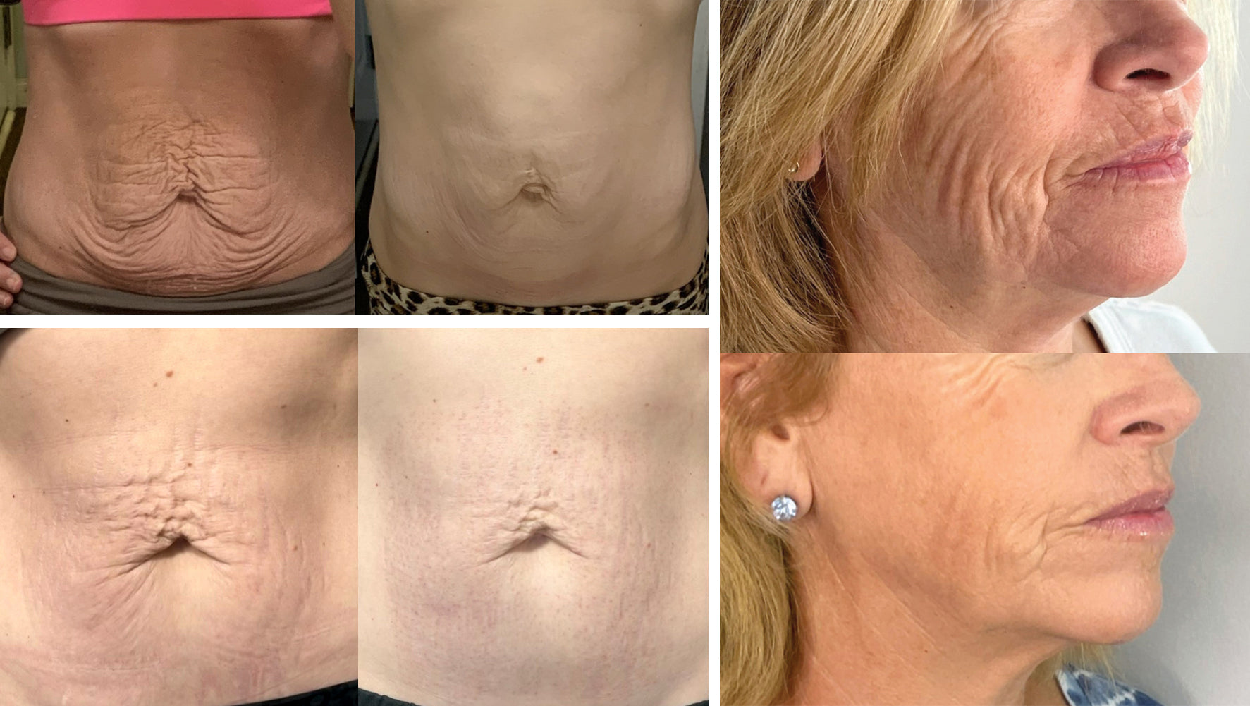 RF Microneedling Before and After Stretch Marks and Wrinkles
