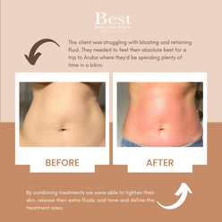 body contouring treatment before and after.