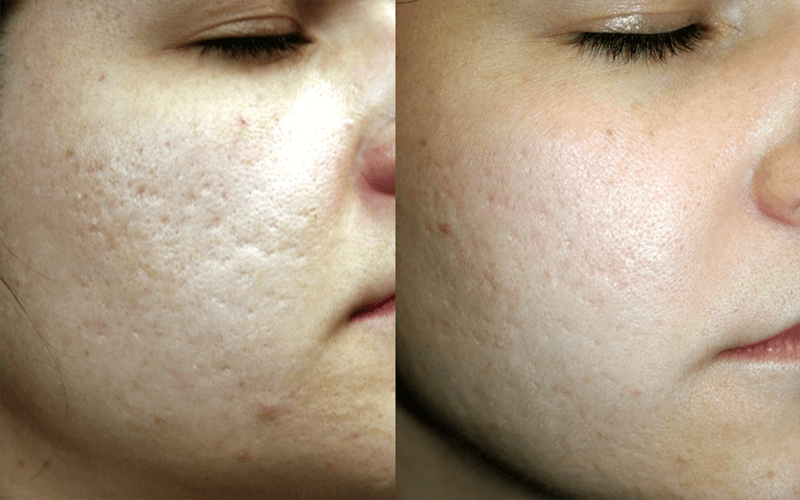 Natural Skin Glow with Collagen Induction Treatment
