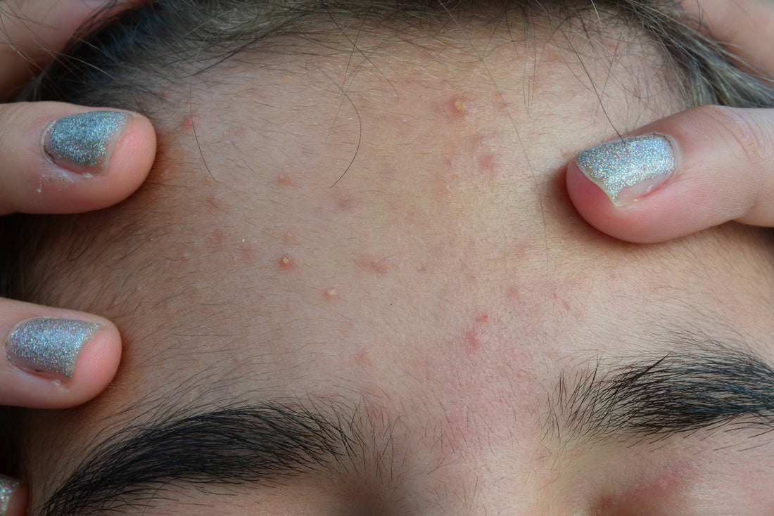 Depressed Acne Scar: Causes And Treatment Options