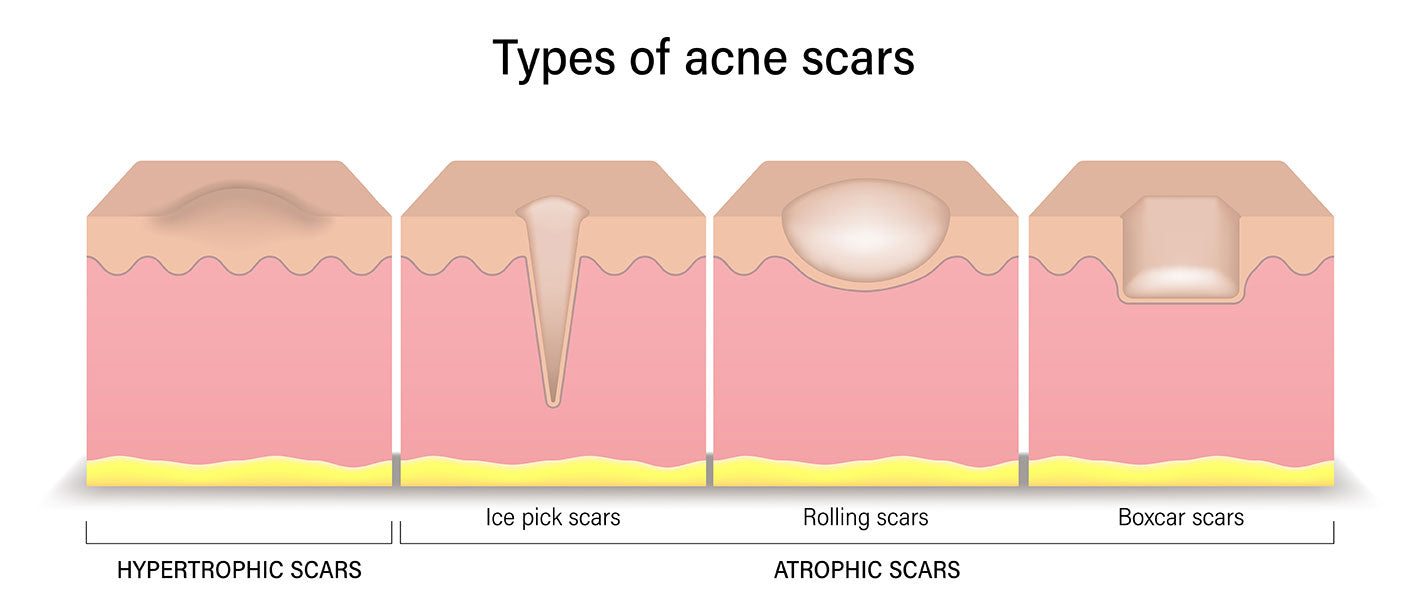 Types of acne scars