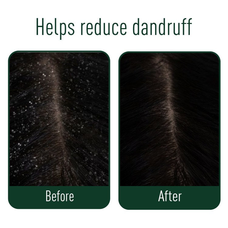 Anti Dandruff Oil - Helps Reduce Dandruff