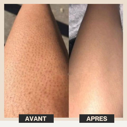 Épilateur Lumière Pulsée,Épilation au laser IPL pour femmes et hommes, mise  à niveau du système d'épilation Ice Compress 999,900 