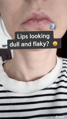 How to Fix Dry, Flaky Lips