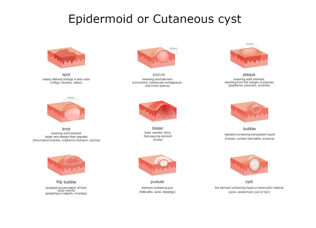 How to remove Epidermoid or cutaneous cyst naturally with supplements
