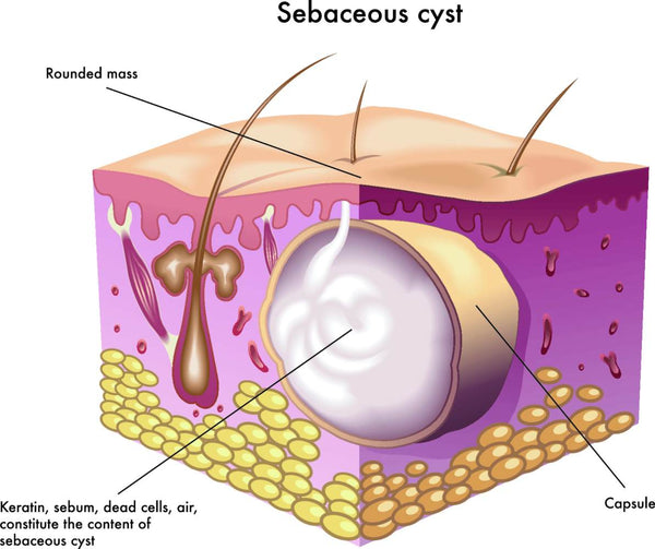 How to remove Sebaceous Cyst naturally with supplements