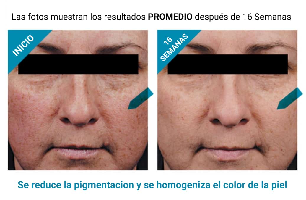 Antes y después de uso de Phloretin CF Skinceuticals