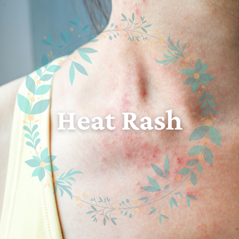 Heat Rash