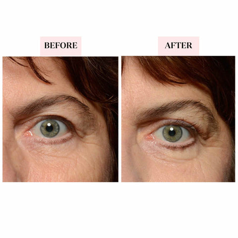 Before and After results of Eyelid Lifting Tapes
