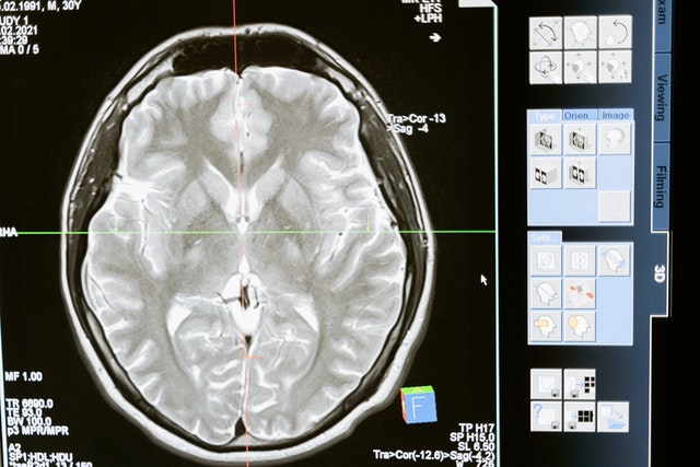 MRI-kuva päästä ylhäältä