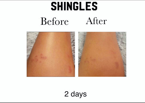 Ms Bee'z Beauty skin oil shingles before and after