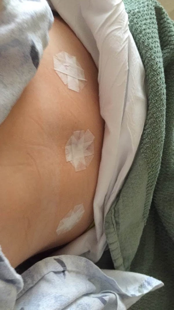 three small incisions on Madi's belly after emergency surgery