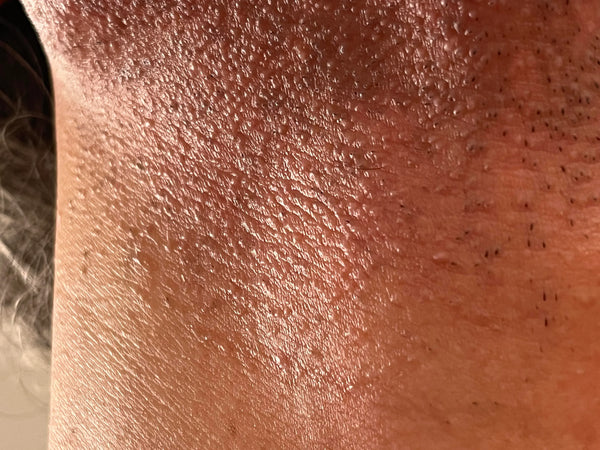 Last van baardbultjes -  pseudofolliculitis barbae