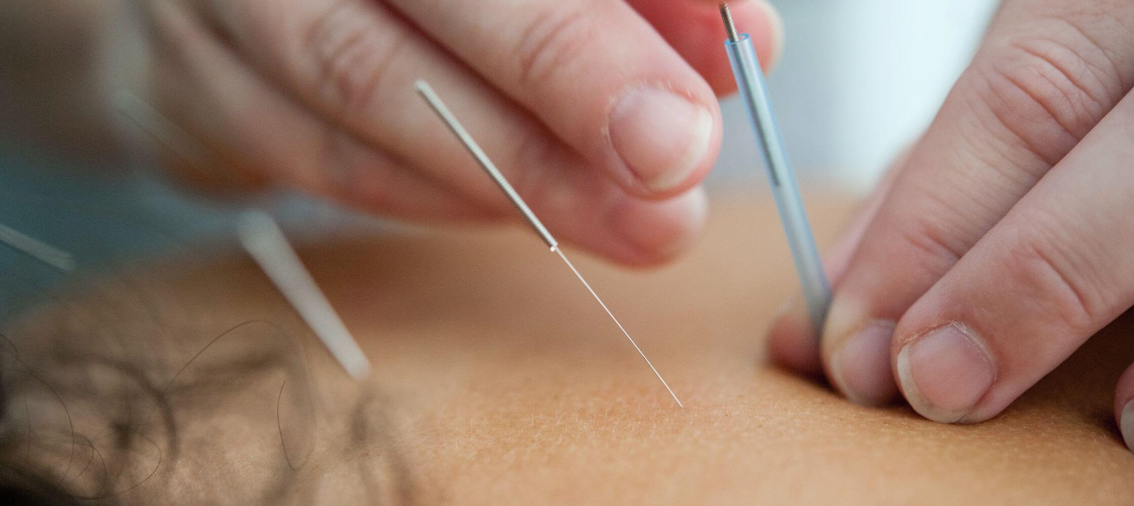 Massage l'acupuncture