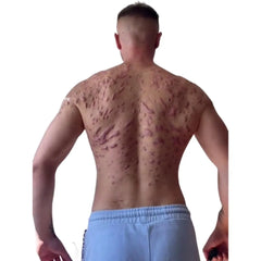 Keloid scarring from anabolic steroids. Credit to @davehartrey on TikTok.