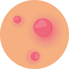 Papules illustration