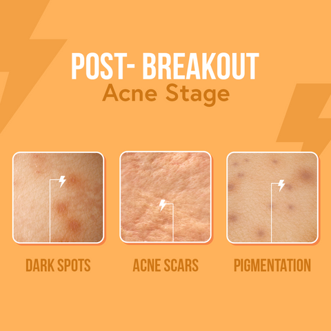 Post breakout stage of acne