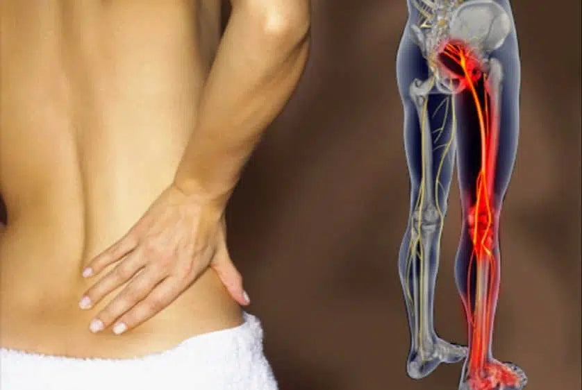 sciatica-pain-relief-treatment-remedies-and-exercises.webp__PID:7fdd777f-d7a7-454b-9109-4533b0187e85