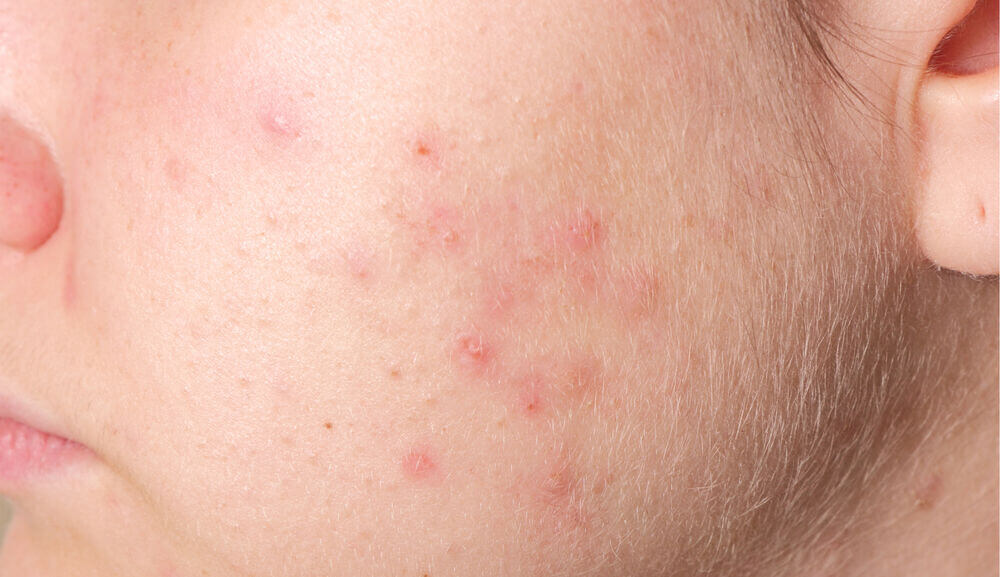 Acne texture skin.jpg