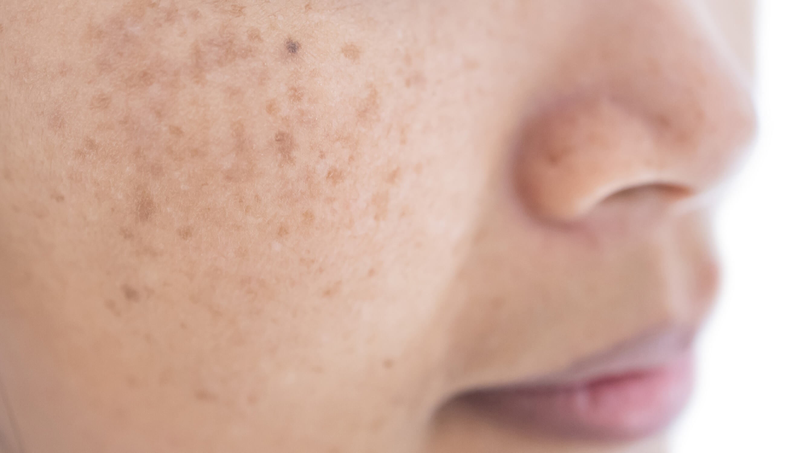 Melasma