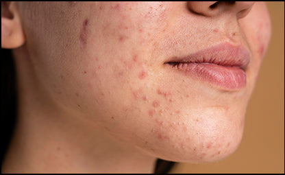 A face of a person with acne, marks and pigmentation