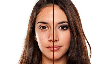 Two sides of the same woman. One with acne and the other with clear and glowing skin