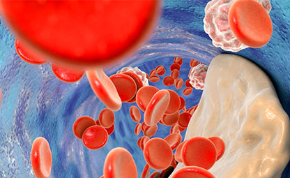 Vector of red blood cells and cholesterol build up in the arteries