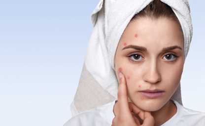 A woman having acne and stress
