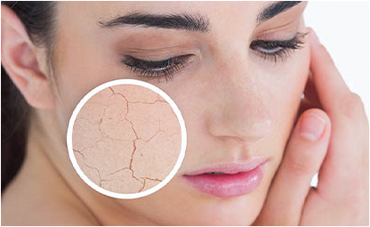 Dry skin of a woman