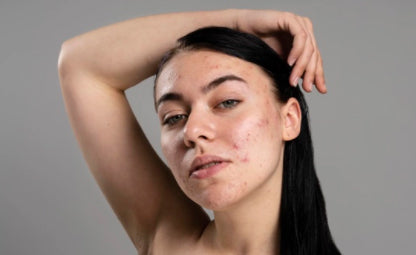 A woman with dull skin with marks and acne