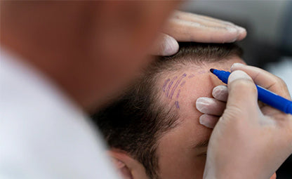 A doctor doing a hair transplant on a patient’s forehead with a marker