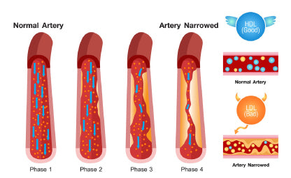 Vector of Cholesterol build-up in the arteries