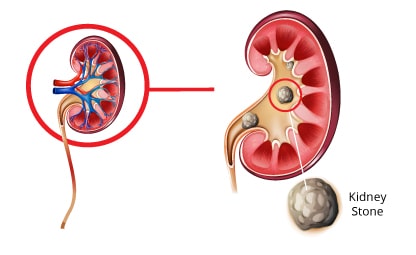 Vector of kidney stones and kidney health