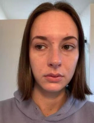 Resultado compartido por Paola E. con LUNELLE™ - Recupera tu mirada juvenil en minutos