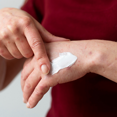 A woman rubbing body butter on inflammed skin