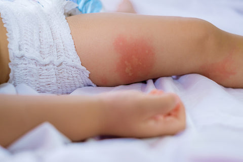 How To Treat Mosquito Bites On Babies