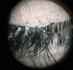 Anterior Blepharitis with False Eyelashes