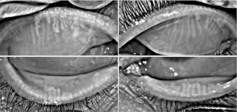 Ocular Rosacea Pictures 3