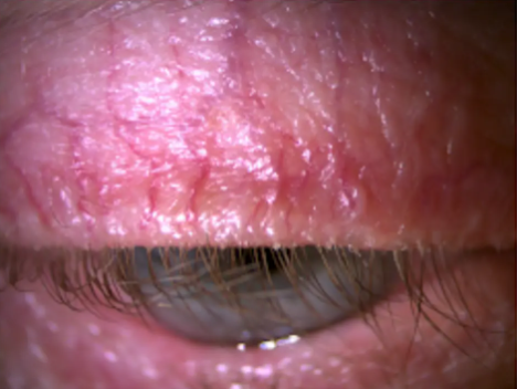 Ocular Rosacea Pictures