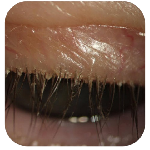 anterior blepharitis