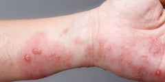 what does scabies look like