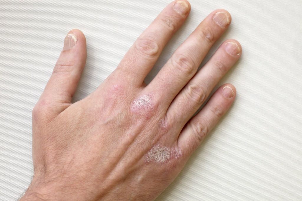 Psoriasis 