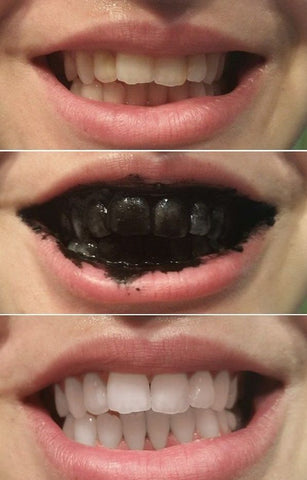 Activated Charcoal Teeth 🦷 Whitening Treatment - Whitens Teeth Naturally, Kills Cavity causing Bacteria &amp; Eliminates Bad Breath